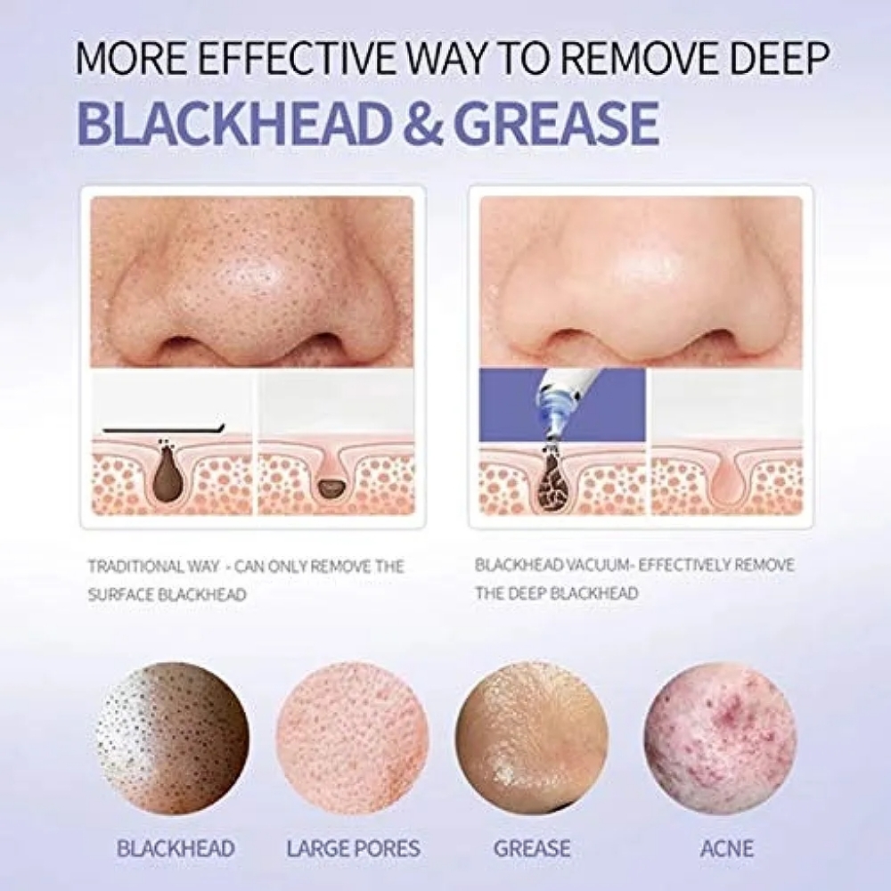 Bulbhead DermaSuction Blackhead Remover - Picture 5 of 6